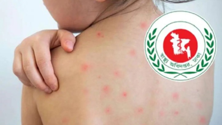 হাম ও হামের উপসর্গ নিয়ে সারা দেশে আরও ৫ শিশুর মৃত্যু