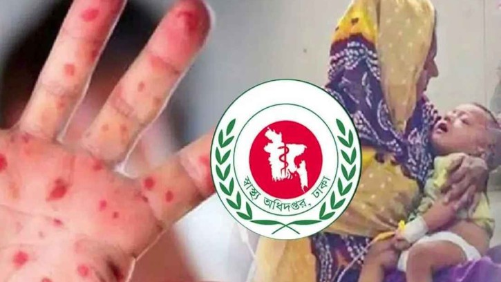 হাম উপসর্গে আরও ৫ শিশুর মৃত্যু